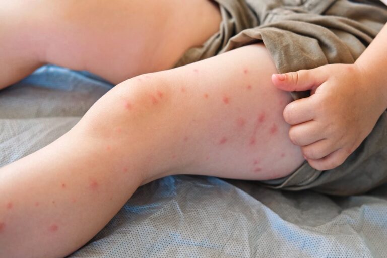 crianca-morre-por-complicacao-rara-do-sarampo-anos-apos-ser-infectada